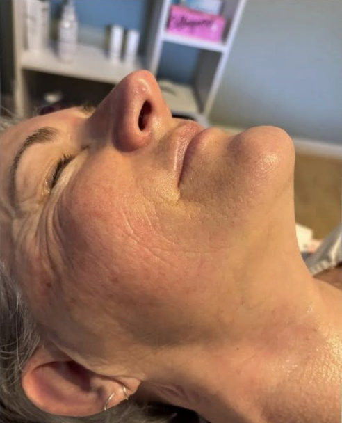 SkinBase Collagen Lift — after treatment