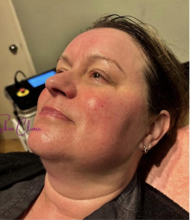 Hydro Facial — after treatment